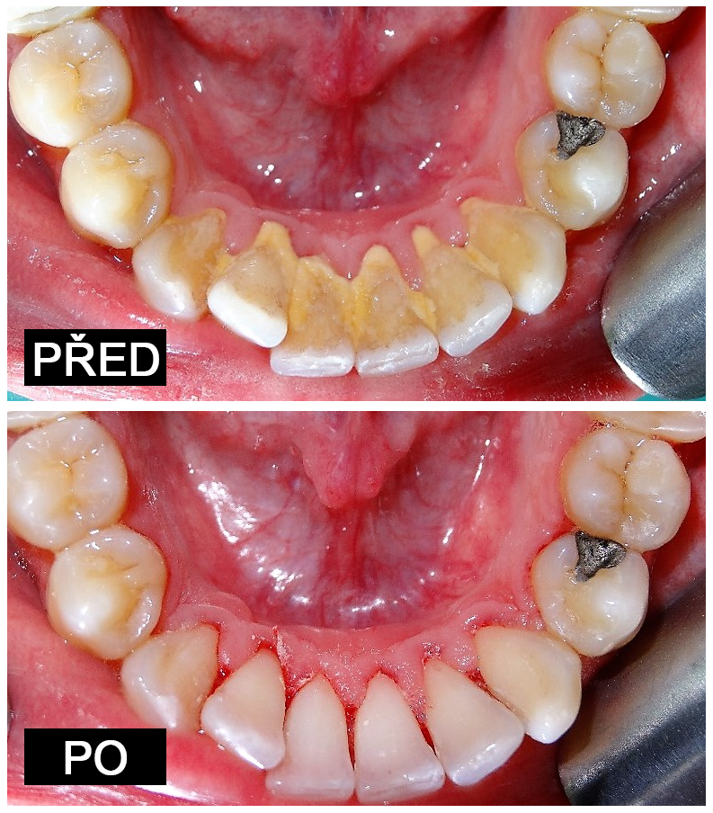 Dentální hygiena před a po 1