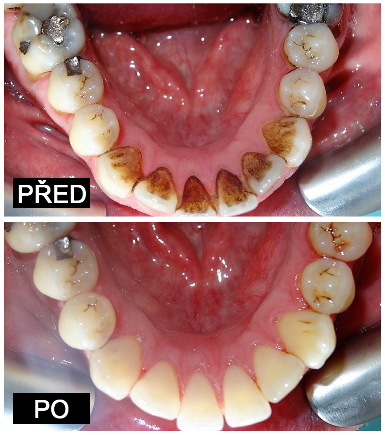Dentální hygiena před a po 2