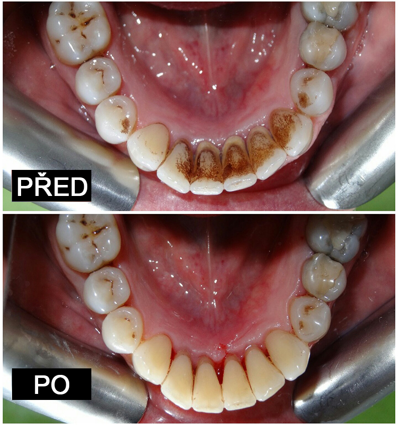 Dentální hygiena před a po 3